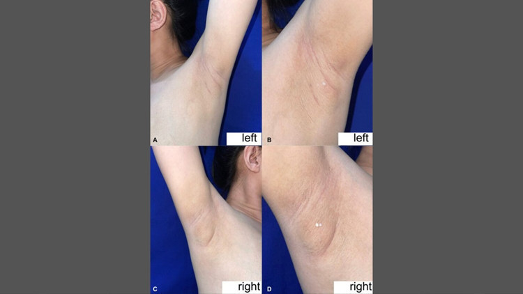 filipinli kadinin koltukaltindan sut geldi nadir gorulen durumun nedeni ne tr4RYYAG.jpg